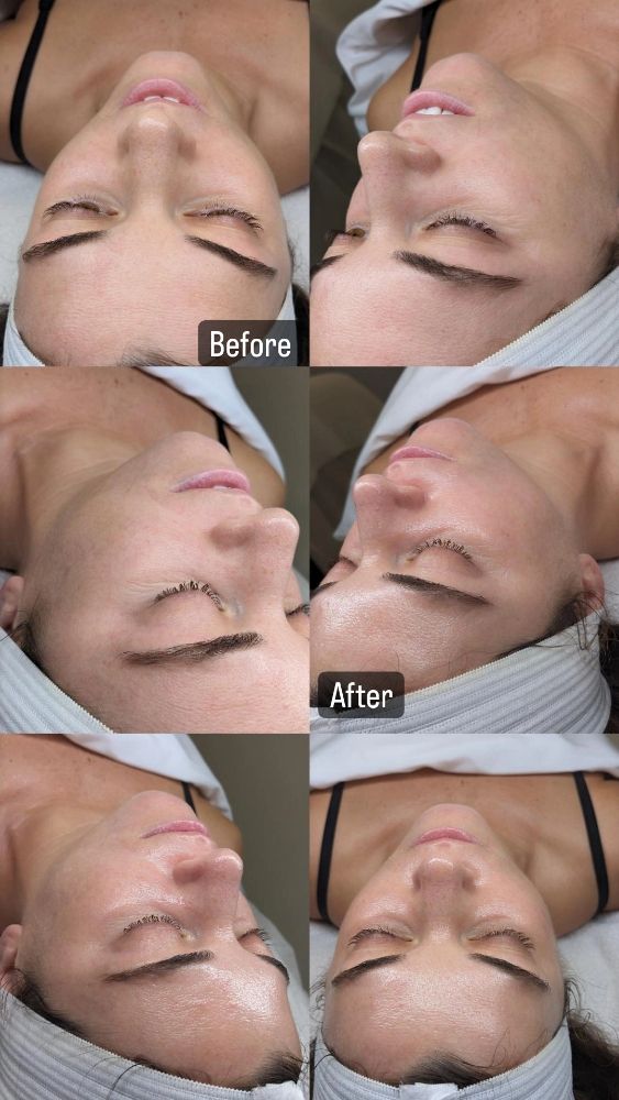 Before and After Facial Treatment