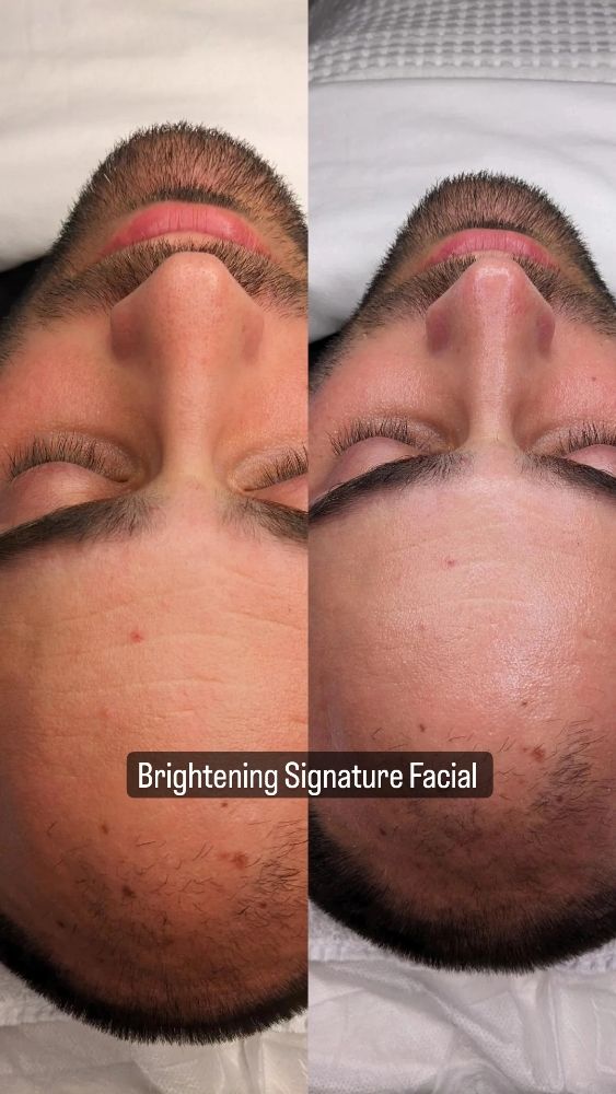 Photos of Brightening Signature Facial