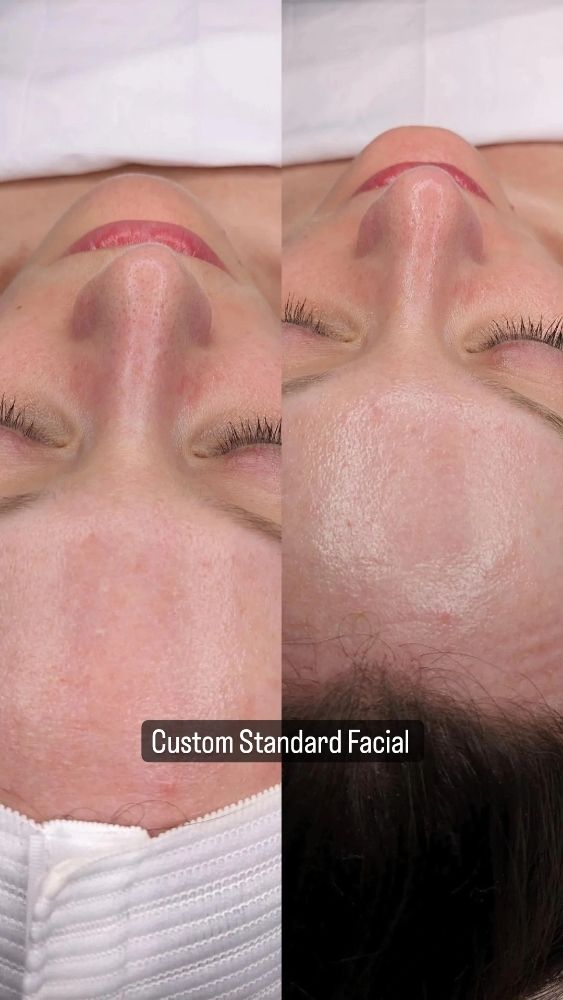 Facial before and after images