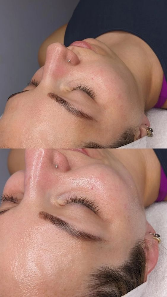 Facial Before After Photos