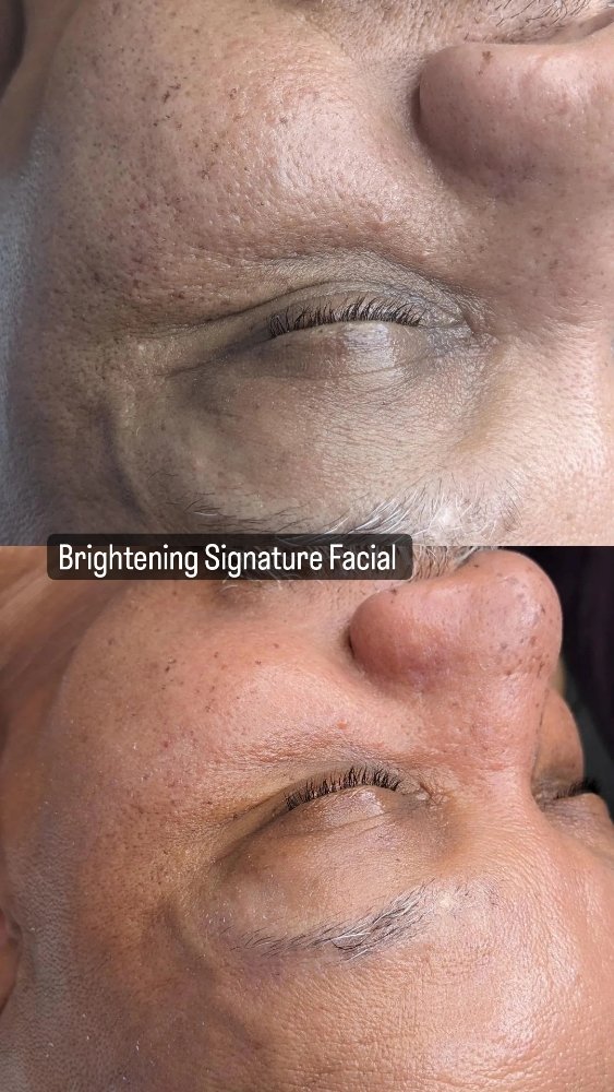 before and after facial