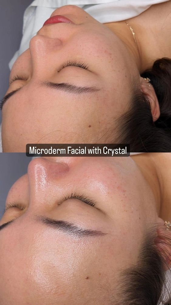 Images of Microderm Facial with Crystal